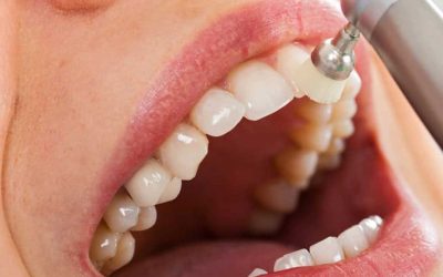 Microabrasión Dental